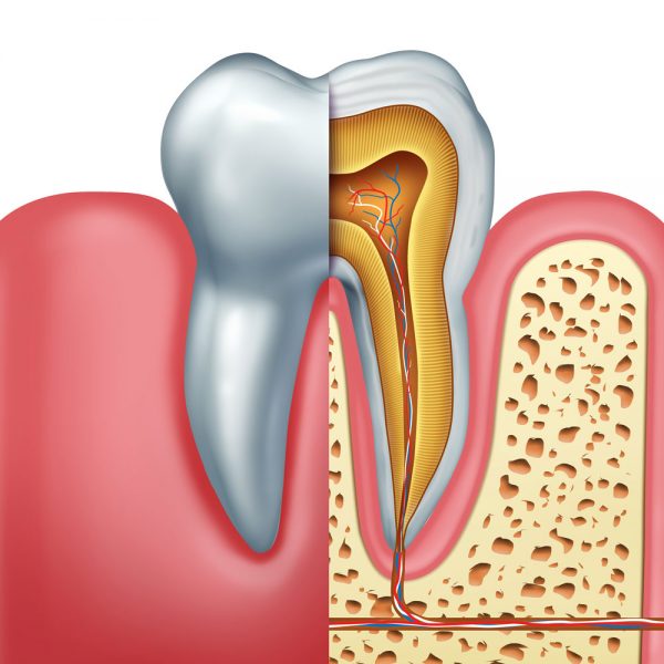Endodoncija - Vadjenje zubnog zivca