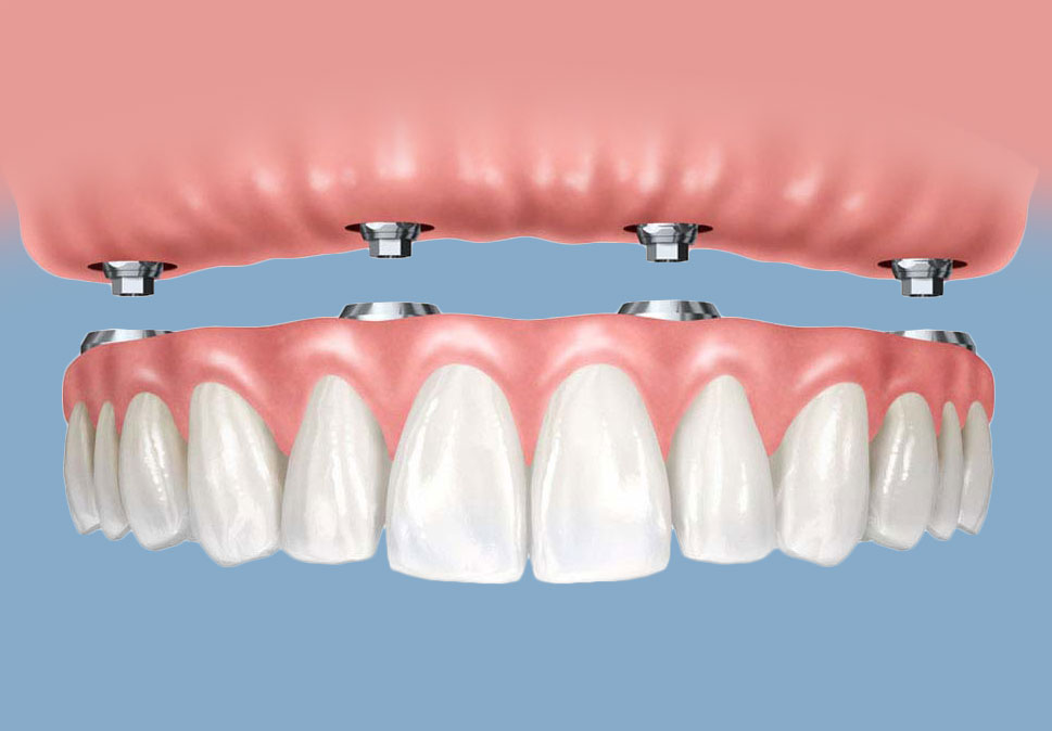 Zubni implanti all-on-four
