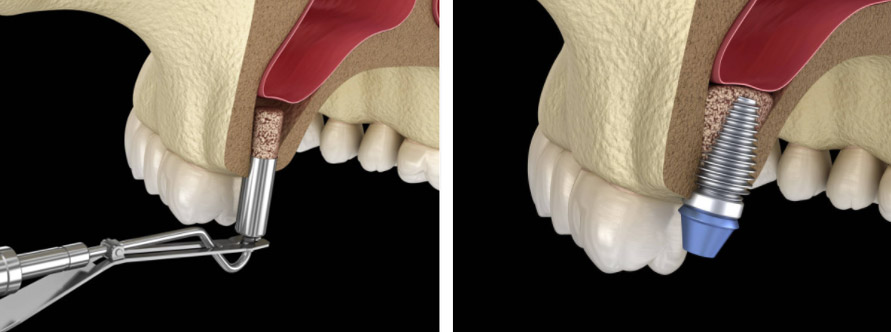 sinus lift i zubni implant